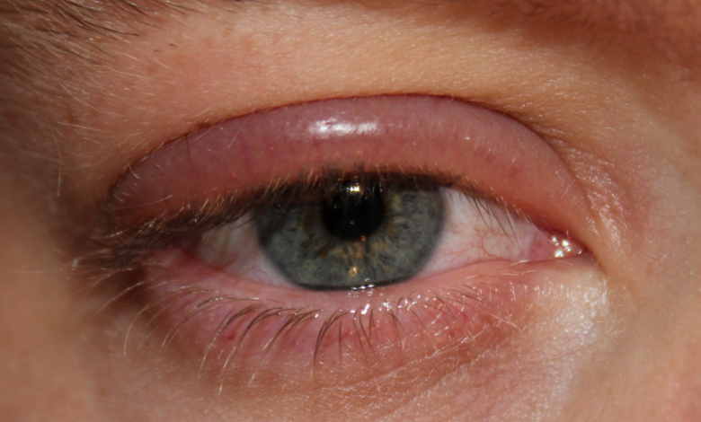 Göz Enfeksiyonu Nedenleri ve Tedavisi Nedir?